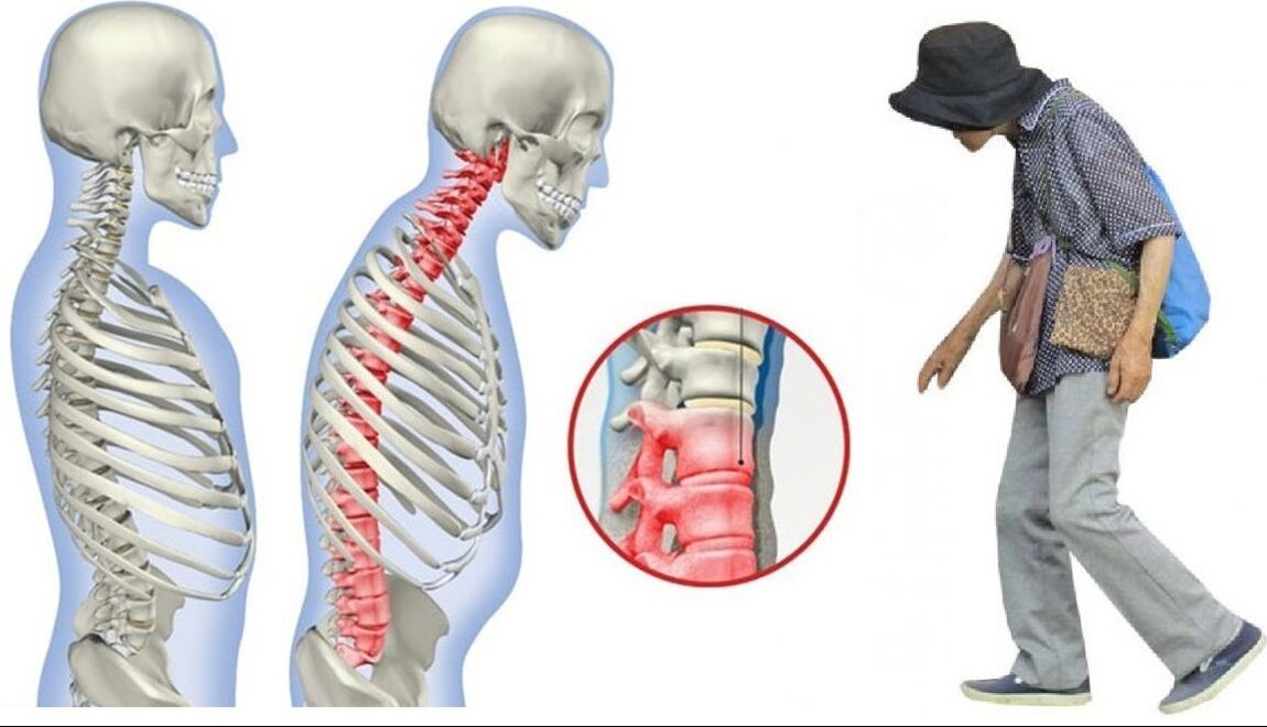 mal de dos dû à la spondylarthrite ankylosante