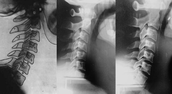 Cou avec un déplacement de la première vertèbre cervicale