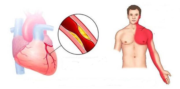 Syndrome cardial